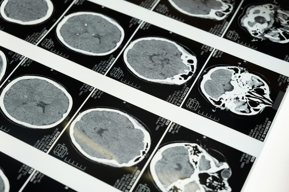 Un Lien Entre Ménopause et Alzheimer : Décryptage des Recherches Récentes