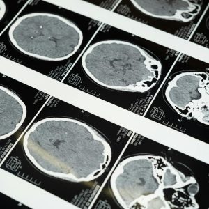 Un Lien Entre Ménopause et Alzheimer : Décryptage des Recherches Récentes